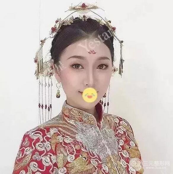 成都艺星6d明星眼双眼皮术后恢复日记