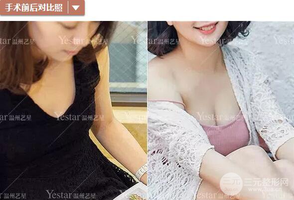 温州艺星谭立文自体脂肪隆胸案例术后恢复实记