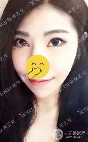 温州艺星打B****案例术后恢复日记