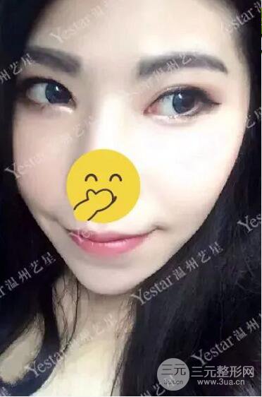 温州艺星打B****案例术后恢复日记