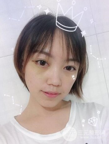 北京内切祛眼袋真人案例果对比分享，年轻十岁不是梦