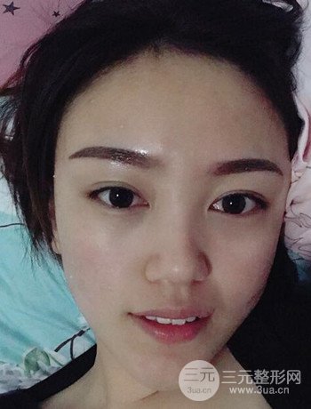 北京内切祛眼袋真人案例果对比分享，年轻十岁不是梦