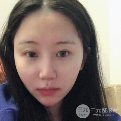 面部吸脂瘦脸日记以及前后对比图分享~