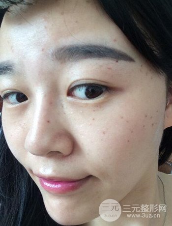 北京激光去雀斑真实案例分享，纯素颜无滤镜果图