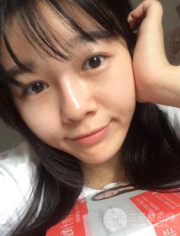 北京激光去雀斑真实案例分享，纯素颜无滤镜果图