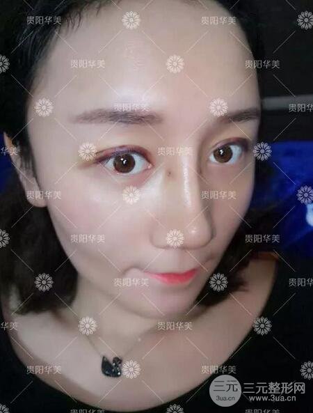 贵阳华美整形田永华双眼皮+隆鼻+脂肪填充术后恢复日记