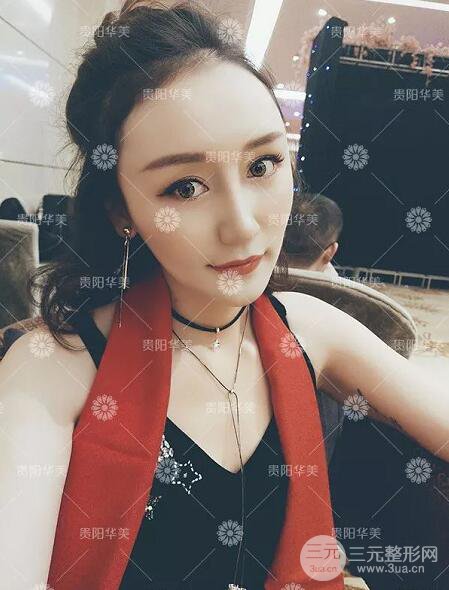 贵阳华美整形田永华双眼皮+隆鼻+脂肪填充术后恢复日记