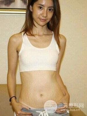 北京301医院激光去妊娠纹案例恢复图片分享