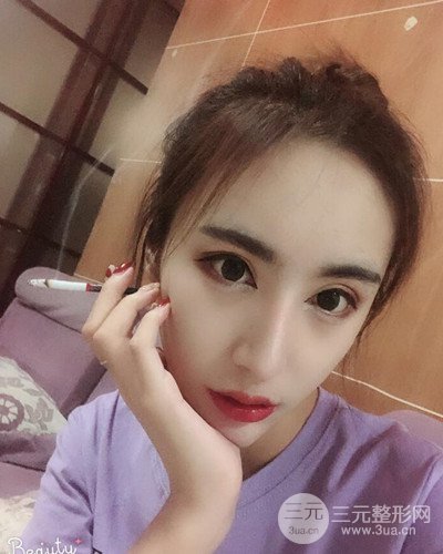 硅胶隆鼻假体取出隆鼻修复手术恢复过程分享