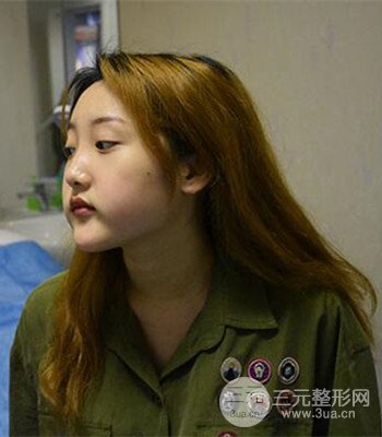 终于做了下颌角整形，分享术后恢复果