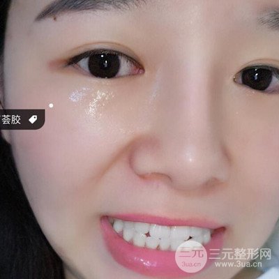 做了牙齿冷光美白果很棒，绽放美丽笑容