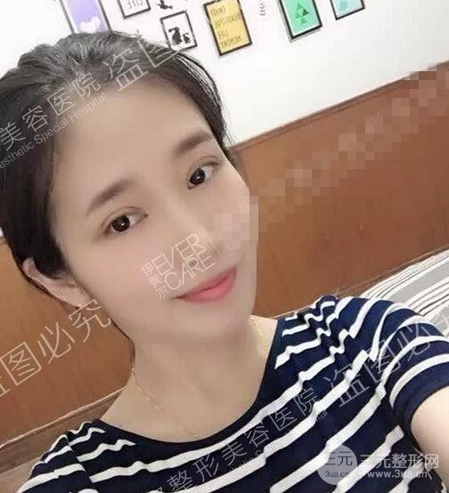 伊美尔秦宏伟双眼皮案例术后15天果图展示