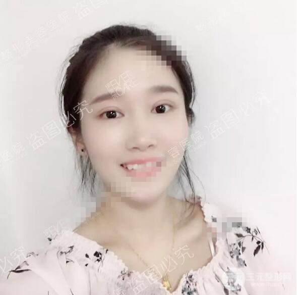 伊美尔秦宏伟双眼皮案例术后15天果图展示