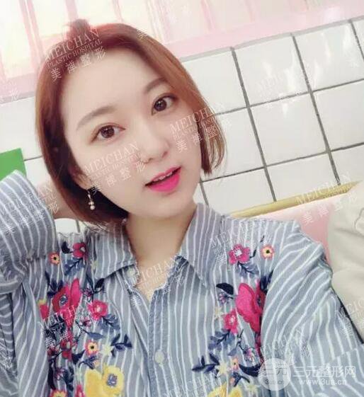 重庆美禅吴一整形医生双眼皮案例恢复记录