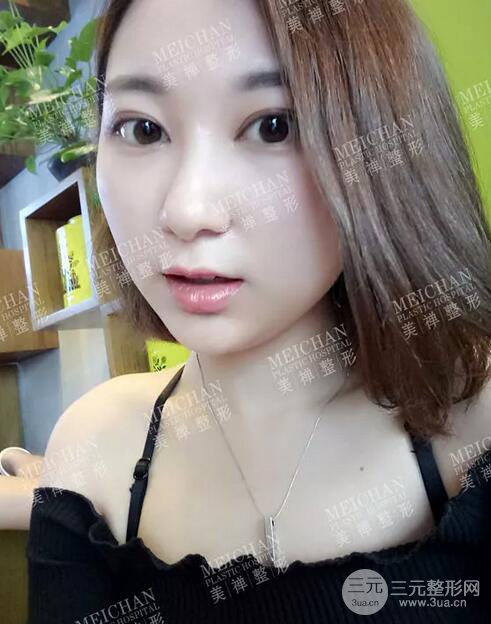 重庆美禅吴一整形医生双眼皮案例恢复记录