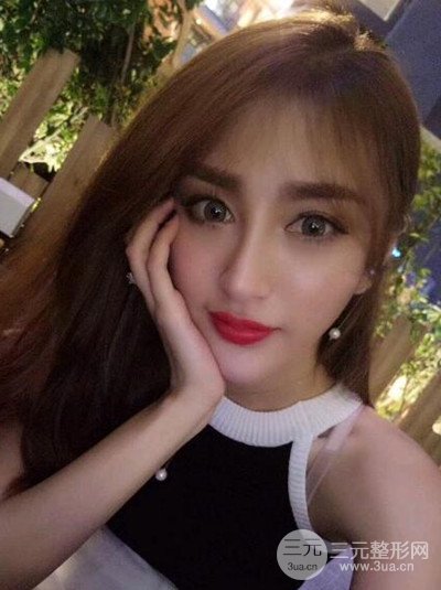 重庆铂生王振荣隆鼻整形前后对比图恢复过程分享