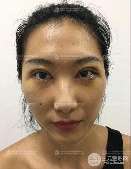 煤炭总医院双眼皮整形案例术后恢复一个月果