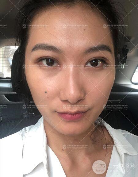 煤炭总医院双眼皮整形案例术后恢复一个月果