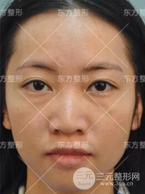 南宁东方刘中策综合隆鼻案例分享