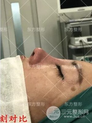 南宁东方刘中策综合隆鼻案例分享