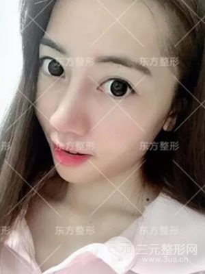 南宁东方刘中策综合隆鼻案例分享