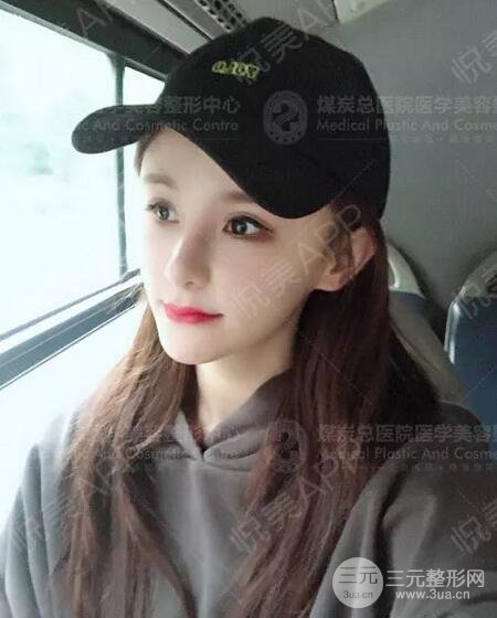 煤炭总医院整形美容科自体脂肪填充案例