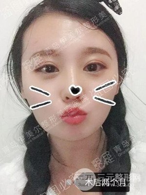 青岛伊美尔隆鼻整形案例恢复过程前后对比图分享