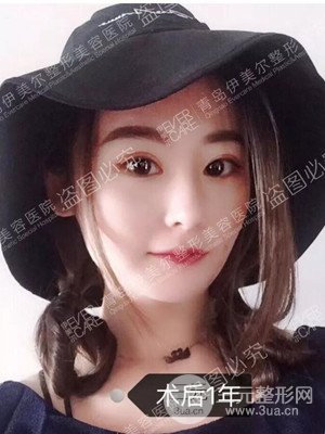 青岛伊美尔隆鼻整形案例恢复过程前后对比图分享