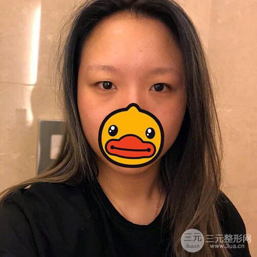 西安爱丁丁合军双眼皮整形案例日记