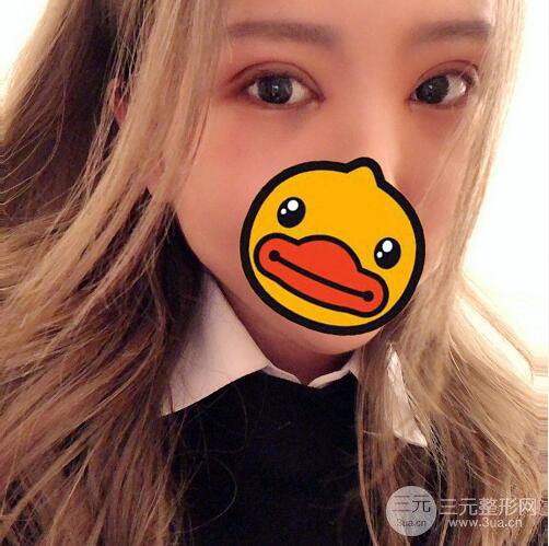 西安爱丁丁合军双眼皮整形案例日记