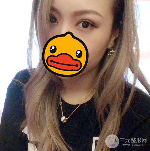 西安爱丁丁合军双眼皮整形案例日记