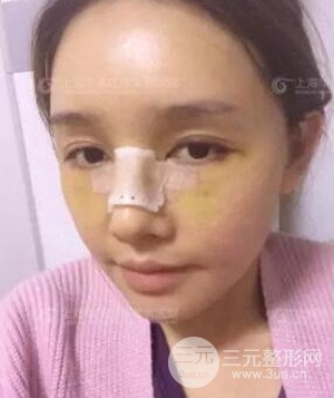 隆鼻失败修复+详细部自体脂肪填充案例分享，上海华美做的!