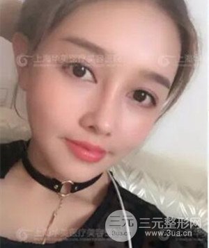 隆鼻失败修复+详细部自体脂肪填充案例分享，上海华美做的!