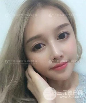 隆鼻失败修复+详细部自体脂肪填充案例分享，上海华美做的!
