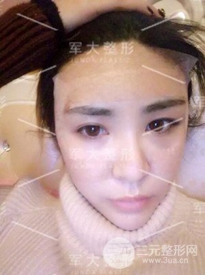 四川军大自体脂肪面部填充案例分享