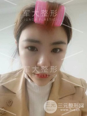 四川军大自体脂肪面部填充案例分享