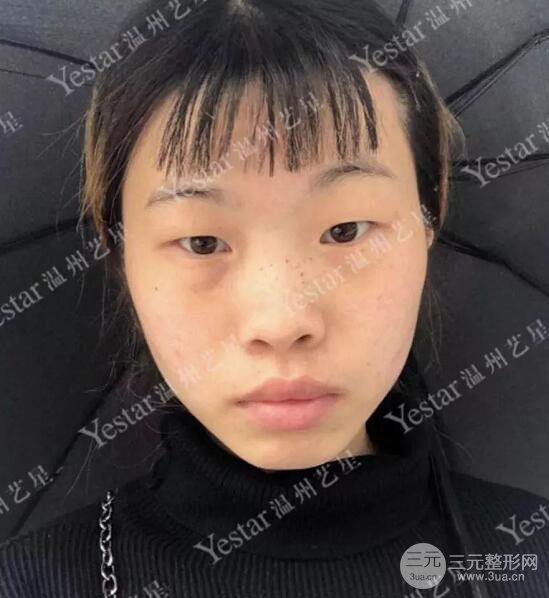 温州艺星双眼皮+隆鼻+自体脂肪填充案例果图片
