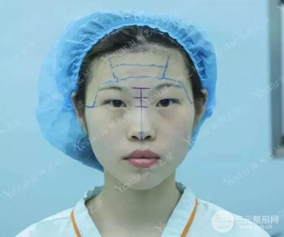 温州艺星双眼皮+隆鼻+自体脂肪填充案例果图片