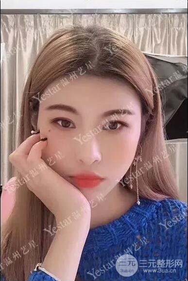 温州艺星双眼皮+隆鼻+自体脂肪填充案例果图片