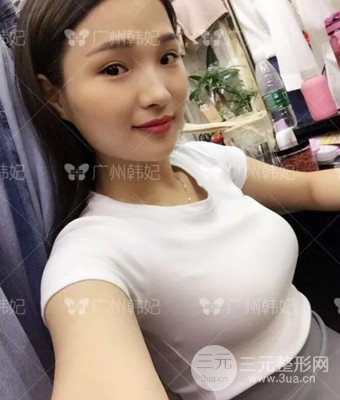 广州韩妃刘志刚自体脂肪丰胸案例前后对比图分享~
