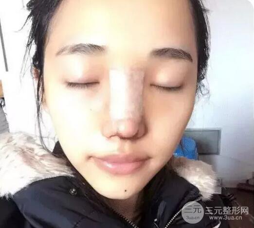 包头叶子冯守云隆鼻案例术后日记
