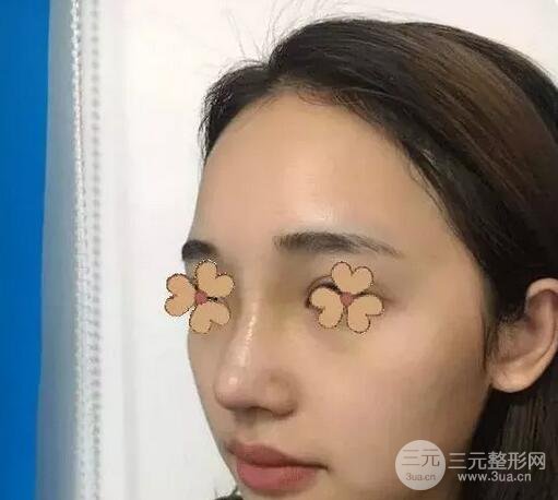 包头叶子冯守云隆鼻案例术后日记