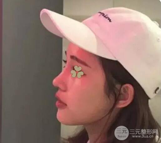 包头叶子冯守云隆鼻案例术后日记