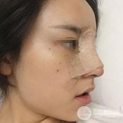 广州艾美周琮镇隆鼻案例前后对比图分享~