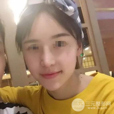 广州艾美周琮镇隆鼻案例前后对比图分享~