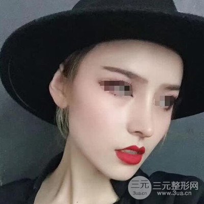 广州艾美周琮镇隆鼻案例前后对比图分享~