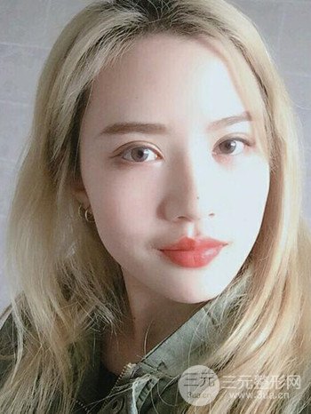 大圆脸做了面部吸脂瘦脸果很棒，立现漂亮鹅蛋脸