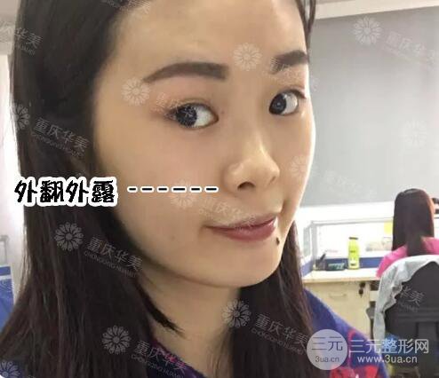 重庆华美潘宝华隆鼻案例合集一览