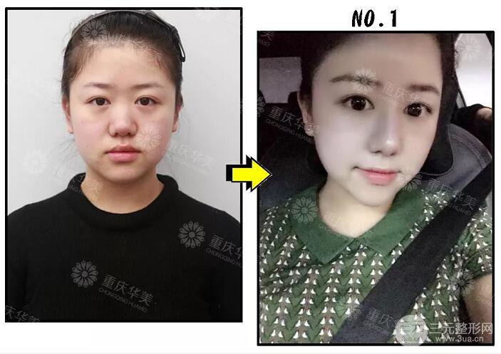 重庆华美潘宝华隆鼻案例合集一览