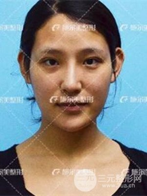 江苏施尔美自体脂肪填充面部案例，前后对比图分享